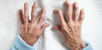 Photo illustrant Comment tu peux gérer les symptômes de l'arthrite de manière naturelle sur le blog https://harmonie-corporelle.fr