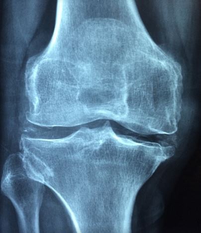 image illustrant Comment tu peux gérer les symptômes de l'arthrite de manière naturelle sur le blog https://harmonie-corporelle.fr